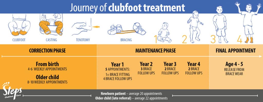 club foot treatment