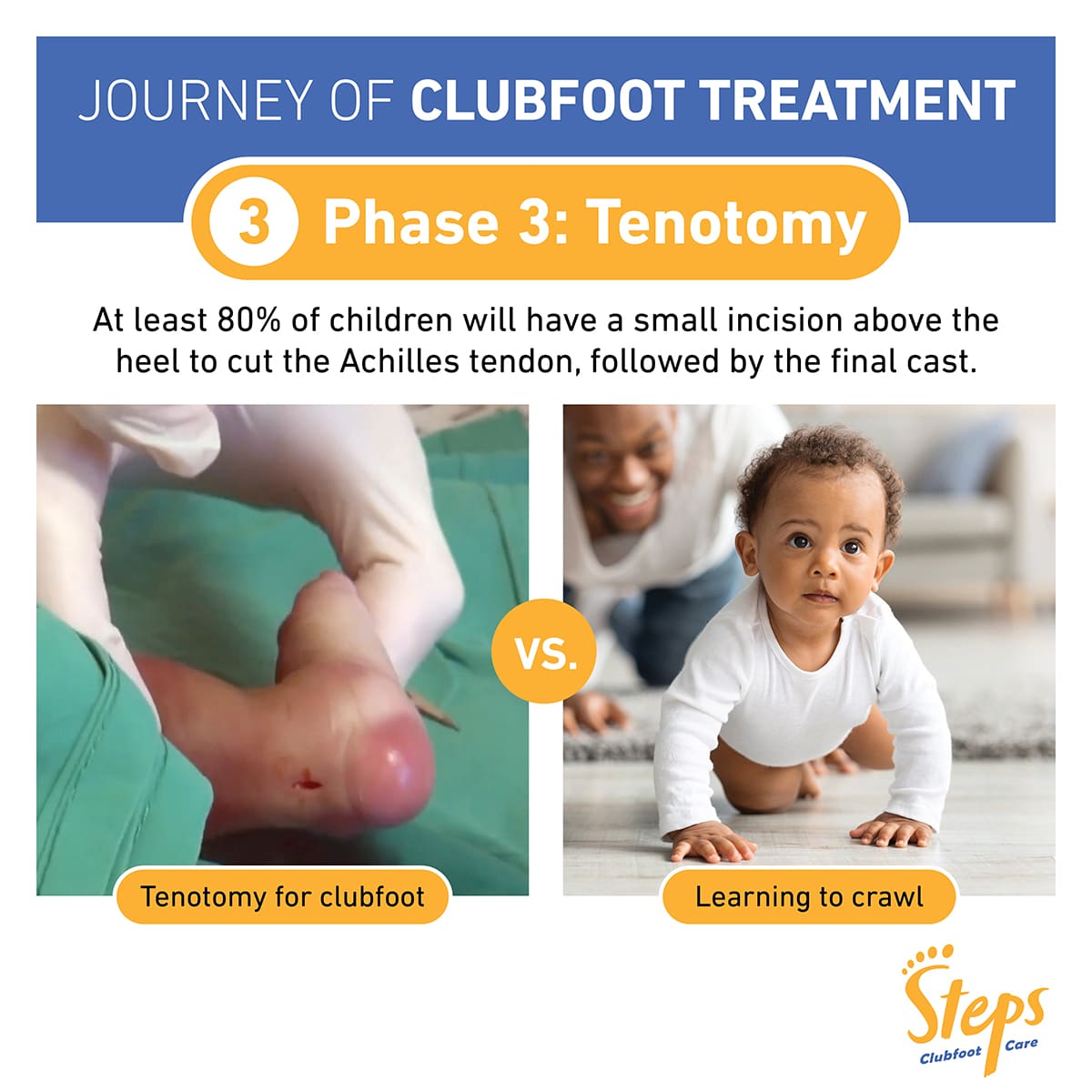 Clubfoot treatment - Steps  Clubfoot support in Southern Africa